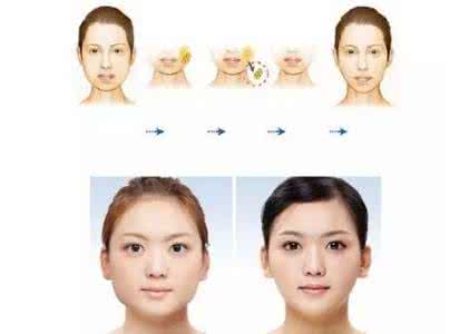 面部吸脂瘦脸手术 面部吸脂瘦脸手术 瘦脸面部吸脂术