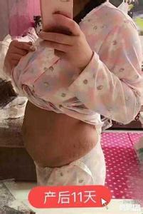 产后子宫下垂真实图片 产后子宫下垂真实图片 同样是生娃产后复出,只有她才最真实