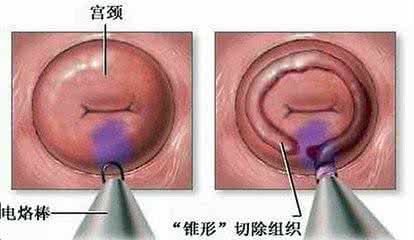 宫颈肥大是什么症状 宫颈肥大是怎么回事?有什么症状?