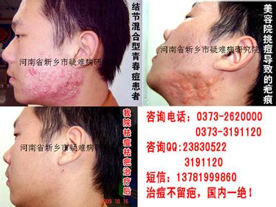 疥疮怎么久治不愈 疥疮为什么久治不愈 为什么青春痘久治不愈 这些错误你犯了吗?