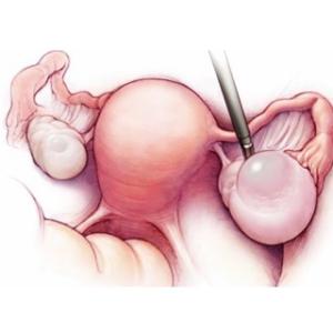 卵巢囊肿破裂的症状 卵巢囊肿破裂 卵巢囊肿破裂是什么导致的