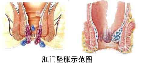 肛门坠胀是什么原因 肛门坠胀是怎么回事 什么原因导致肛门坠胀