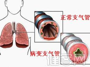 中医治疗支气管扩张 支气管扩张治疗 中医如何治疗支气管扩张