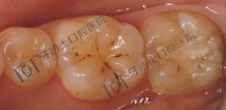 虫牙发炎 虫牙发炎 儿童虫牙发炎怎么办