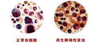 再障贫血的表现 再障贫血 它的特点都有哪些