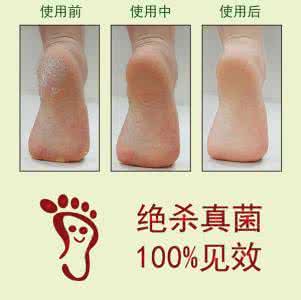 脱皮型脚气怎么根治 脱皮脚气怎么根治 用家庭常用物品治疗脚气