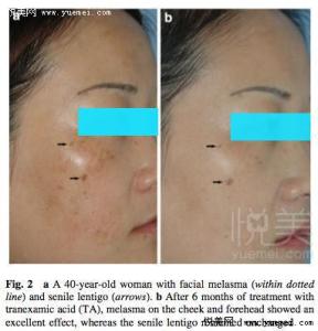 氨甲环酸治疗黄褐斑 氨甲环酸 氨甲环酸治疗黄褐斑