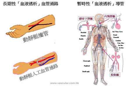 血液透析血管通路 血液透析血管通路ppt 纯天然的血管清洁工，软血管、净血液，记下来做给家人吃~