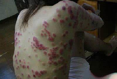 艾滋病恐惧症怎么消除 艾滋病是怎么产生的 艾滋病恐惧症