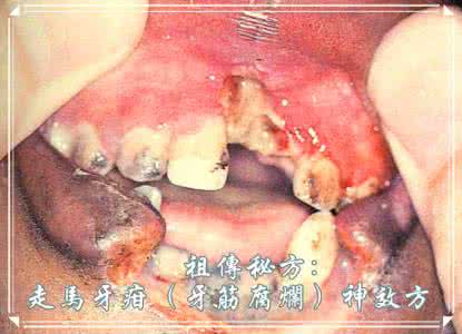 苗药祖传秘方 筋骨王 祖传秘方：走马牙疳（牙筋腐烂）神效方大黄丁香醋