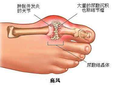 大盐热敷治疗哪些疾病 大盐热敷治疗哪些疾病 热姜水可治疗哪些疾病