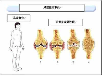 风湿关节炎发病原因 风湿关节炎是什么原因 风湿关节炎发病原因