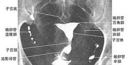 做输卵管造影的时间 做输卵管造影的时间与什么有关