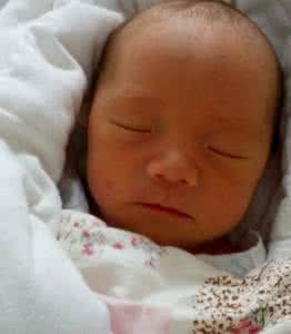 新生儿泪囊堵塞的症状 婴儿泪囊堵塞