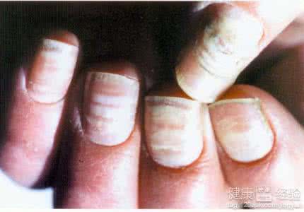 看灰指甲要多少钱 灰指甲 看灰指甲要多少钱？