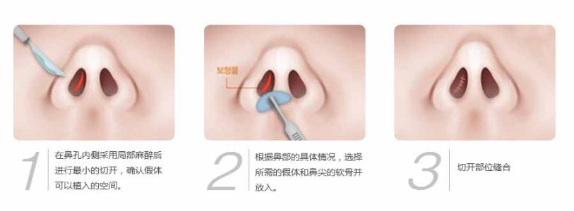 假体隆鼻可以维持多久 假体隆鼻能管多久 假体隆鼻的效果能维持多久？