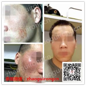 激素依赖性皮炎 激素依赖性皮炎 激素依赖皮炎为什么难治疗？激素依赖皮炎治疗误区