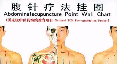 腹针疗法 腹针疗法 什么是腹针疗法