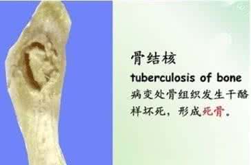 张锡纯屡试屡验效方 专治骨结核秘方,屡试屡验*