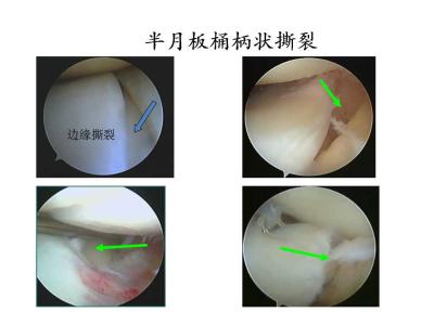 半月板损伤多久能恢复 半月板损伤如何恢复 半月板损伤多久能好
