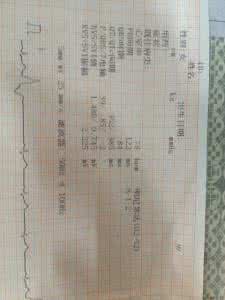 心脏早搏有什么症状 心脏早搏有什么症状 心脏早搏会有的症状