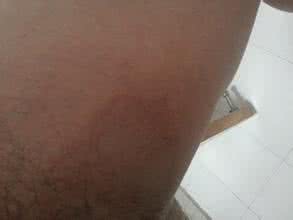 股癣传染吗 股藓会传染吗 股癣会传染吗？