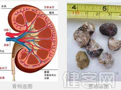 治肾结石.尿道结石 肾结石和尿道结石 鹿角霜治肾结石尿道结石秘方