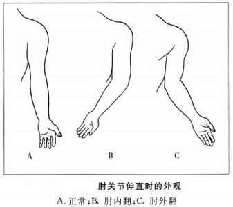 小腿肚外翻纠正方法 肘外翻 诊断肘外翻的方法