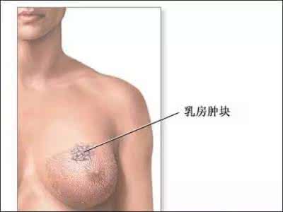 hpv16阳性几年得癌症 乳房X光照射假阳性 小心10年内癌症真的来袭