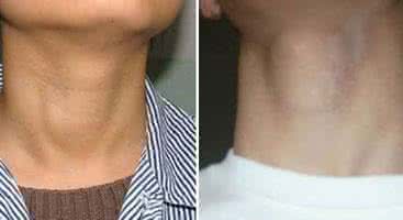 治疗牙周炎的民间秘方 【民间秘方】治疗甲状腺囊肿