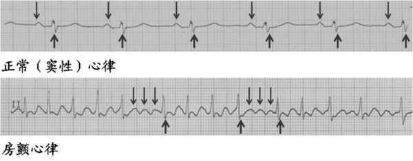 心脏房颤是什么症状 你知道什么是房颤吗？