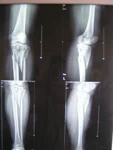 胫骨后唇骨折症状 胫骨轻微骨折什么症状 胫骨骨折的症状特征是什么