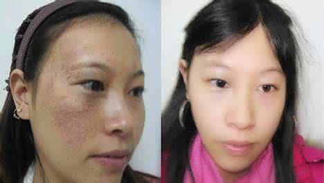 女朋友脸上长痘痘 女朋友脸上长痘痘 长痘的朋友来算算你脸上有多少条虫在爬