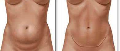 腹壁整形术 腹壁整形术 腹壁整形