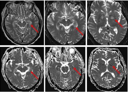 脑内多发缺血灶 神经元 局灶性脑缺血后嗜酸性神经元死亡的通路