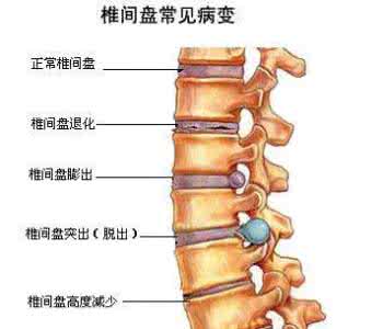 腰椎盘突出骨质增生 腰椎盘突出骨质增生 腰椎间盘突出是什么？和骨质增生有什么区别以及联系？