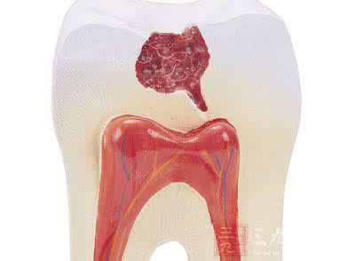 牙槽脓肿怎么治疗 牙槽脓肿  牙槽脓肿怎么治疗