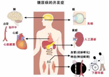 糖尿病并发症及其危害 糖尿病并发症 糖尿病及糖尿病并发症的临床案例