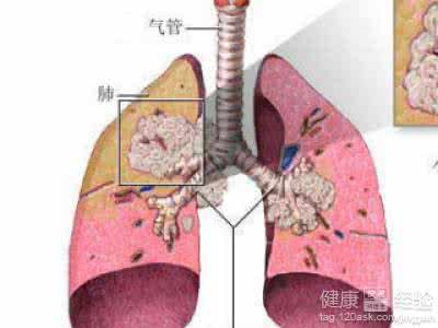 肺大泡是怎么形成的 肺大泡是怎么形成的 肺大泡病因