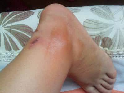 下肢静脉血栓能治愈吗 腿肿小心静脉血栓