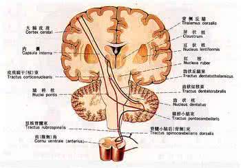 脑干出血怎么治疗 脑干出血 脑干出血应该如何进行治疗