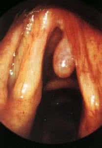声带息肉治疗最佳方法 声带息肉1方