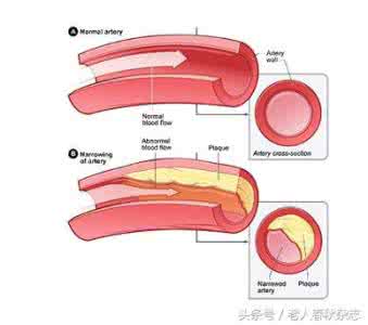 如何降血脂和胆固醇 血脂异常高发 胆固醇“含冤”中枪