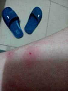 肛门奇痒的症状 红肿奇痒的症状起因红肿奇痒