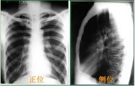 肺不张 秘方治疗、肺痨、肺不张、肺无力、肺气肿！