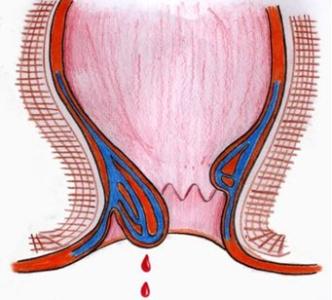 产后便血能自愈吗 产后便血