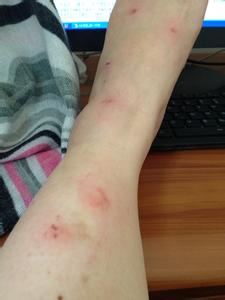 脸上长红疹子怎么办 满身长红疹子怎么回事？