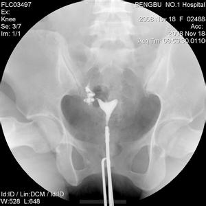 输卵管造影检查步骤 输卵管造影如何检查 输卵管造影检查的优势