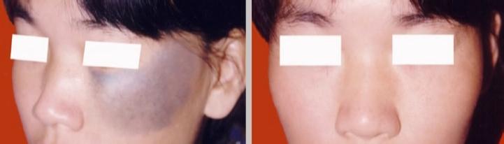 治疗太田痣最权威医院 治疗太田痣最权威医院 治疗太田痣最权威的医院