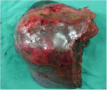 原发性肝癌 原发性肝癌 如何防治原发性肝癌